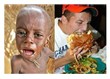 Somali ve dünyada açlık