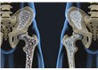 Çocuklarda Osteoporoz Çanları Çalıyor!