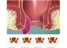 Hemoroid ile anal fissür (makat çatlağı) arasındaki farklar ve tedavisi