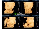 3D Ultrason ve 4D Ultrason Nedir Farkı Nedir?