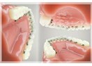 Lingual Ortodonti Üzerine Bir Derleme