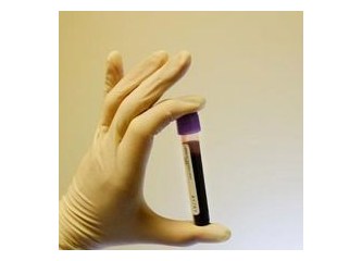 PSA Testi - Total PSA/Serbest PSA değerleri ve Prostat Kanseri