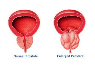 Prostata iyi gelen bitkiler & Prostat büyümesi (BPH) tedavisi