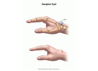 Ganglion da neymiş?