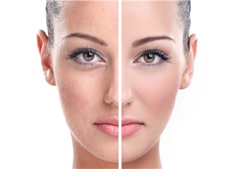 Dermapen ile PRP tedavisi