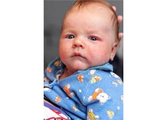 Bebek Egzaması Neden Olur Geçer mi Tedavisi Bebeğim Egzama Oldu Bebek Egzaması Neden Olur Geçer mi Tedavisi Bebeğim Egzama Oldu