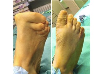 10 Soruda Hallux Valgus (Başparmak Kemik Çıkıntısı)