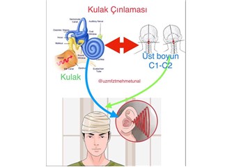 Tinnitus (Kulak Çınlaması)