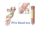 PSA Testi ve Prostat Kanseri