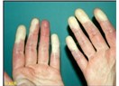 Raynaud Fenomeni hastalığına yakalanan kadın devamlı eldiven giyiyor