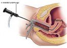 Histeroskopi
