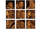 Gebelik takibinde 4 boyutlu ultrasonografi