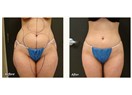 Liposuction ameliyatı