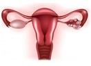 Endometriozis (çikolata kisti) tedavi edilebilir mi?