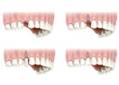 Diş İmplant Tedavisi Hakkında Sık Sorulan Sorular: