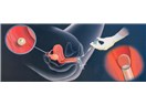 İntra uterin inseminasyon (aşılama)