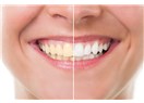 Dişlerinizin Sararmasına Nasıl Engel Olabilirsiniz?