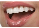 Diş beyazlatma nedir? Nasıl uygulanır?
