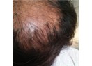 Liken Pilanopilaris nedir, saç kaybında saç ekimi yapılabilir mi?