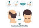 FUE (Folicular Unite Transplantation) Saç Ekimi Yöntemi