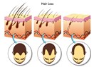 Saç Oto Klonlama Nedir? Saç Botoksu Nedir?  Saç Dolgusu Nedir?  İşe Yarar mı?