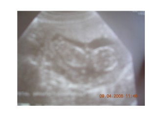 Hamilelikte ilk üç ay