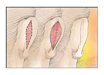 Kulak estetiği (Otoplasty) işlemi ve sonrası