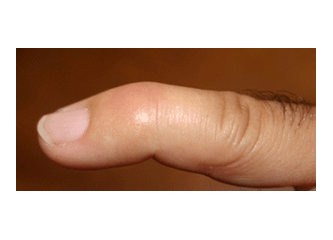 Mallet Finger ( Çekiç Parmak )