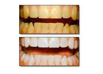 Daha Beyaz Dişler için Bleaching Tedavisi