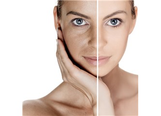 Kimyasal Peeling