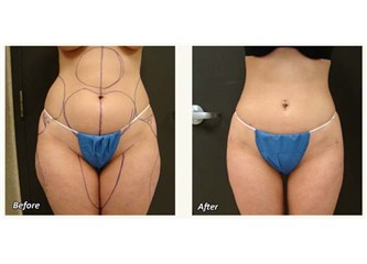 Liposuction ameliyatı