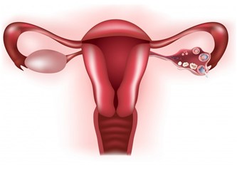 Endometriozis (çikolata kisti) tedavi edilebilir mi?