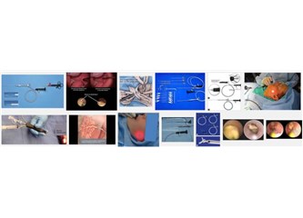Sialendoskopi (Tükürük Bezi Endoskopisi)