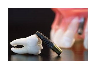 Diş implanti nedir ?