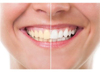 Dişlerinizin Sararmasına Nasıl Engel Olabilirsiniz?