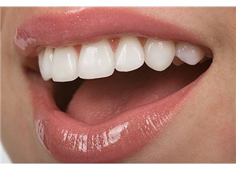 Diş beyazlatma nedir? Nasıl uygulanır?