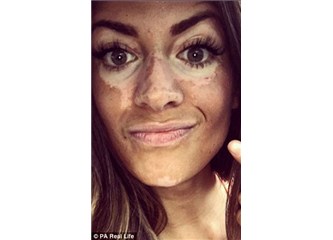 Vitiligo ile yaşamak