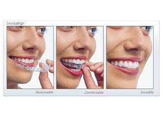 İnvisalign Ama Neden?