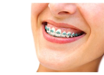 Diş teli dişlere zararlı mı?