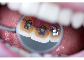 Lingual ortodonti tedavisi