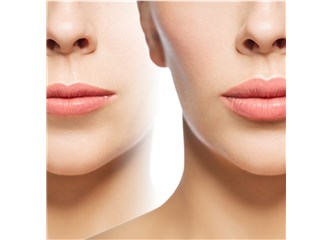 Lip lift : Burun ile dudak arası mesafeye estetik dokunuş