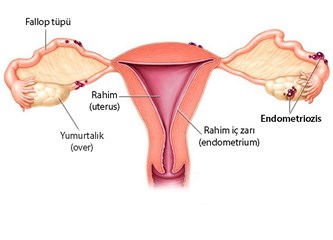 Endometriozis (Çikolata Kisti) Tedavisi